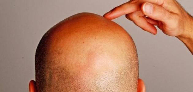 ما هو علاج خلل الهرمونات ما هو علاج خلل الهرمونات