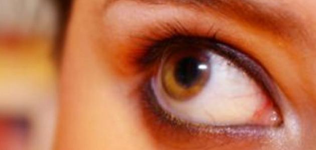 ما هو علاج ظفرة العين ما هو علاج ظفرة العين