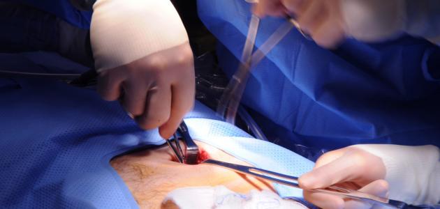 ما هو فتق البطن ما هو فتق البطن