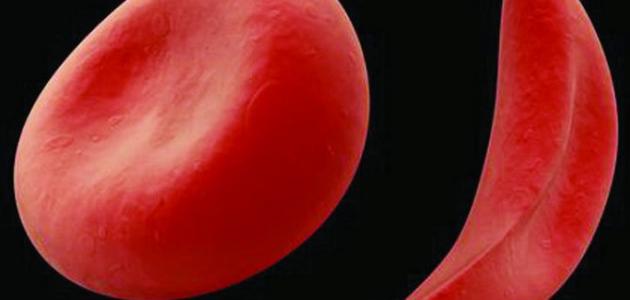 ما هو فقر الدم المنجلي