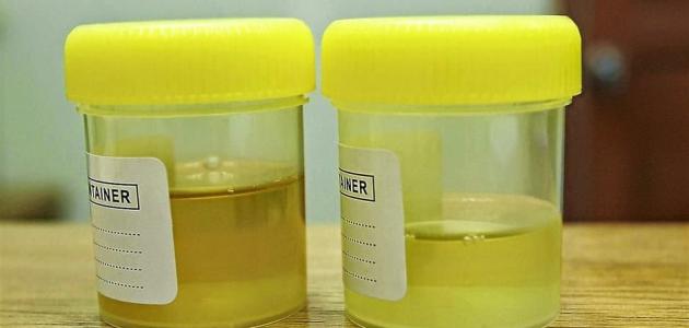 ما هو لون البول الطبيعي ما هو لون البول الطبيعي