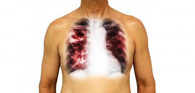 ما هو مرض الدرن وطرق الوقاية منه