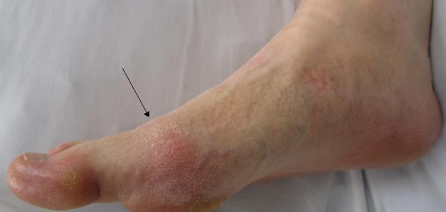 ما هو مرض النقرس ما هو مرض النقرس