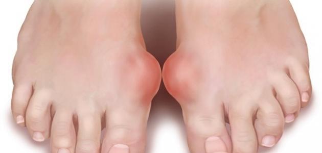 ما هو مرض النقرس و كيف يتم علاجه ما هو مرض النقرس و كيف يتم علاجه