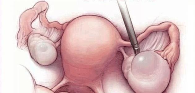 ما هو مرض تكيس المبايض ما هو مرض تكيس المبايض