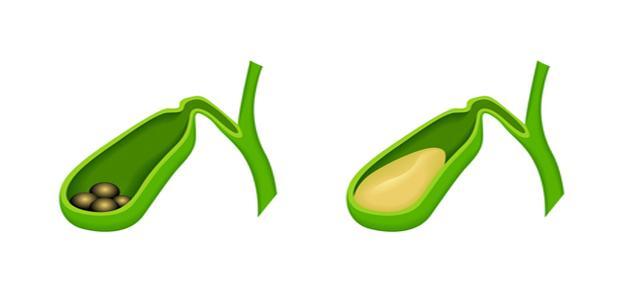 ما هي أسباب تكون حصوات المرارة ما هي أسباب تكون حصوات المرارة