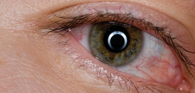 ما هي أسباب قرحة القرنية ما هي أسباب قرحة القرنية