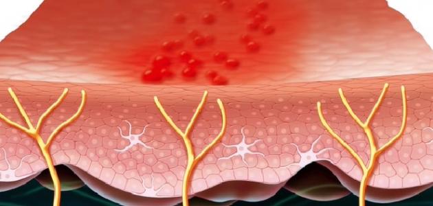 ما هي أسباب مرض الحزام الناري ما هي أسباب مرض الحزام الناري