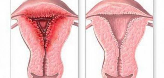 ما هي أعراض التهابات الرحم ما هي أعراض التهابات الرحم