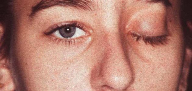 ما هي أعراض العصب السابع ما هي أعراض العصب السابع