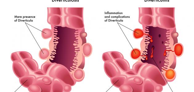 ما هي أعراض الناسور