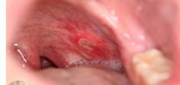 ما هي أعراض قرحة القولون