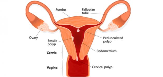 ما هي أعراض لحمية الرحم ما هي أعراض لحمية الرحم