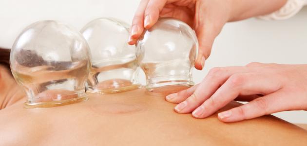 ما هي الحجامة وما فوائدها ما هي الحجامة وما فوائدها