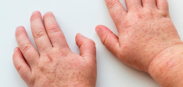 ما هي الحمى القرمزية ما هي الحمى القرمزية