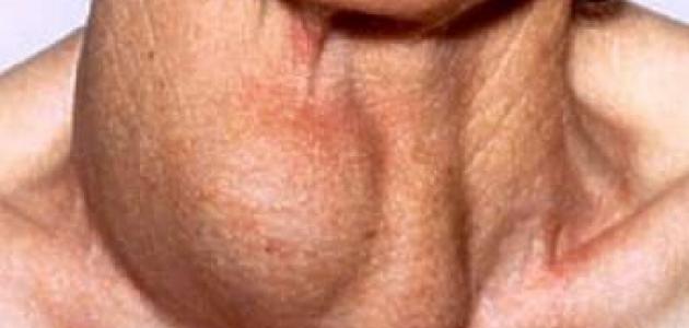 ما هي الغدد اللمفاوية