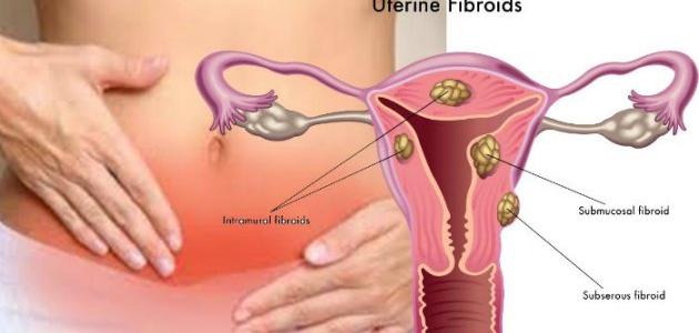 ما هي الياف الرحم ما هي الياف الرحم