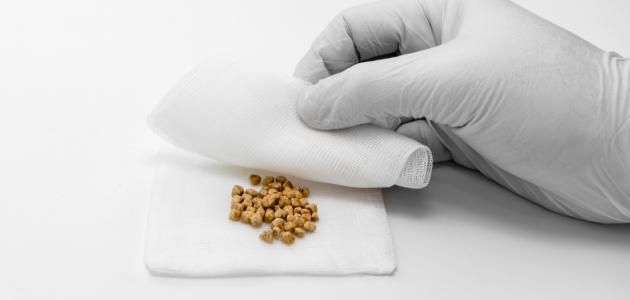 ما هي حصوة المرارة ما هي حصوة المرارة