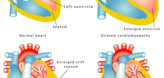 ما هي دعامات القلب ما هي دعامات القلب