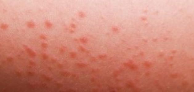 ما هي شرية البرد ما هي شرية البرد