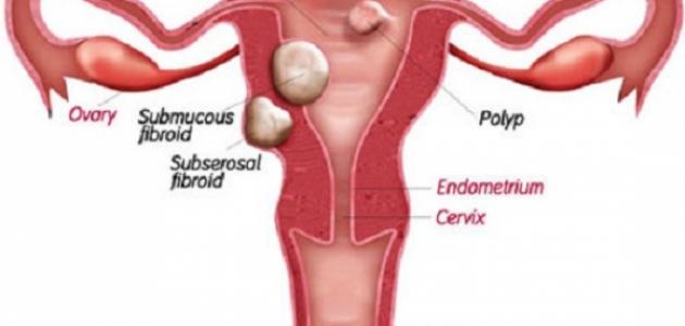 ما هي قرحة الرحم ما هي قرحة الرحم