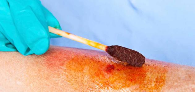 مراحل شفاء الحروق مراحل شفاء الحروق