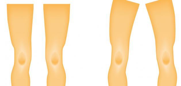 مرض الكساح مرض الكساح