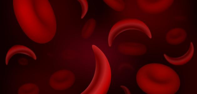 مرض فقر الدم مرض فقر الدم