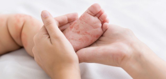 مسبب مرض الحصبة مسبب مرض الحصبة