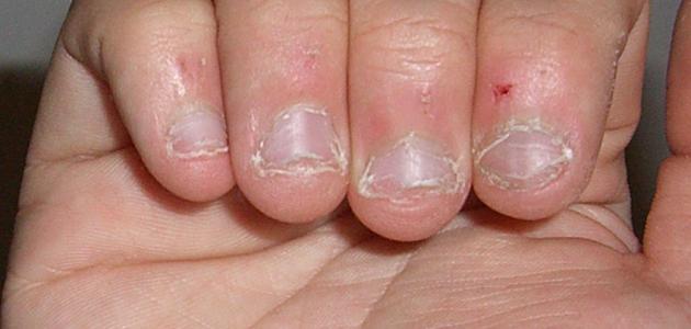 مشكلة قضم الأظافر عند الكبار مشكلة قضم الأظافر عند الكبار