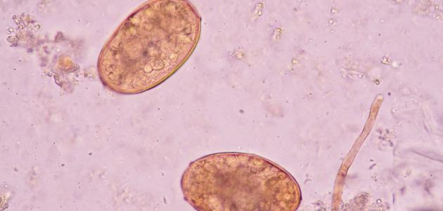 مضاعفات البلهارسيا مضاعفات البلهارسيا