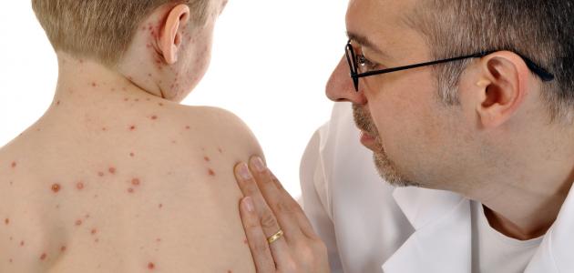 مضاعفات مرض الحصبة مضاعفات مرض الحصبة