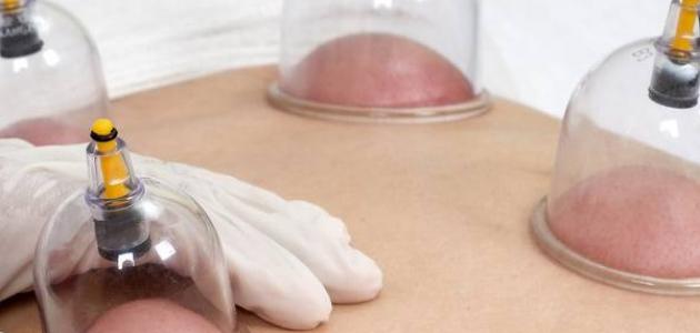 هل الحُجامة مُفيدة لحدوث الحمل؟ هل الحُجامة مُفيدة لحدوث الحمل؟