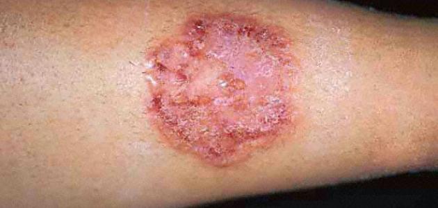 هل تعدي فطريات القطط الإنسان هل تعدي فطريات القطط الإنسان