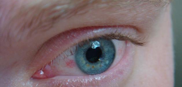 هل ضغط العين يسبب العمى هل ضغط العين يسبب العمى