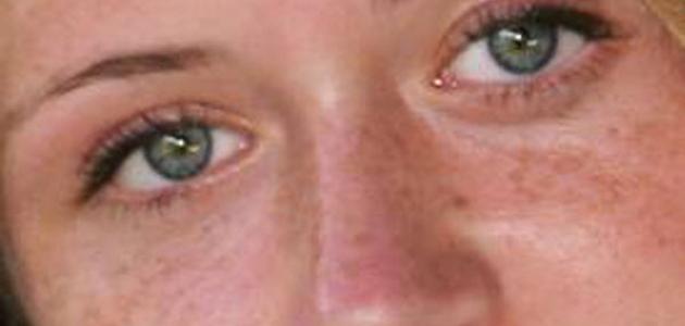 وصفات لإزالة الكلف عن الوجه وصفات لإزالة الكلف عن الوجه