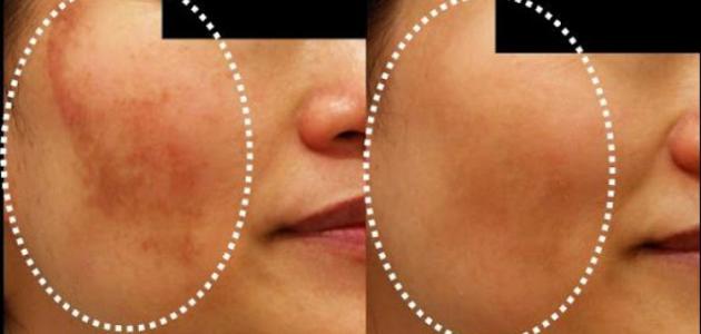 وصفة لإزالة الكلف من الوجه وصفة لإزالة الكلف من الوجه