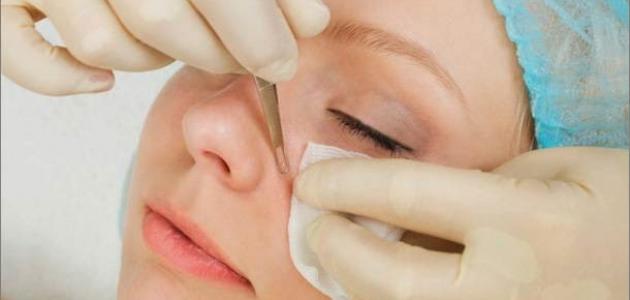 وصفة لإزالة الكلف وتبييض الوجه وصفة لإزالة الكلف وتبييض الوجه