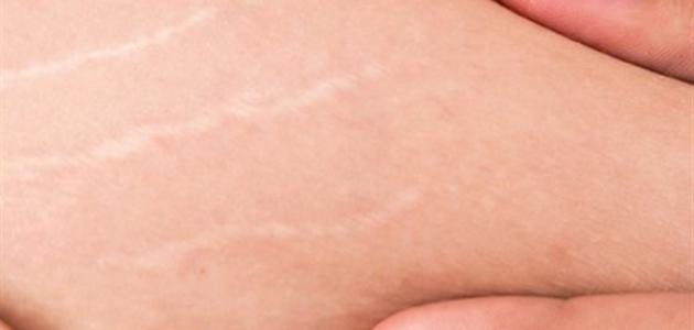 وصفة لإزالة تشققات البطن بعد الولادة وصفة لإزالة تشققات البطن بعد الولادة