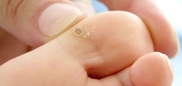 وصفة لعلاج مسمار القدم وصفة لعلاج مسمار القدم