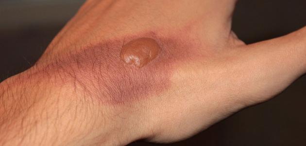 آثار حروق الدرجة الأولى