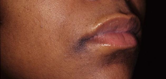 أسباب اسوداد الوجه أسباب اسوداد الوجه