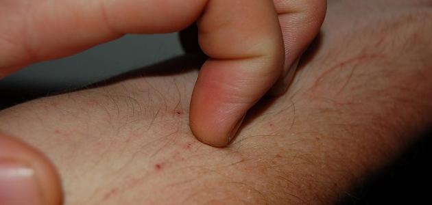 أسباب الحكة في الجسم والاحمرار أسباب الحكة في الجسم والاحمرار