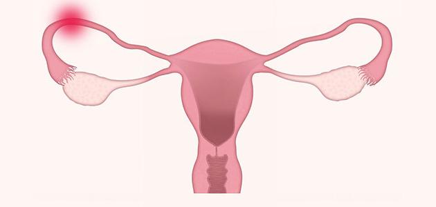 أسباب انسداد قناة فالوب أسباب انسداد قناة فالوب