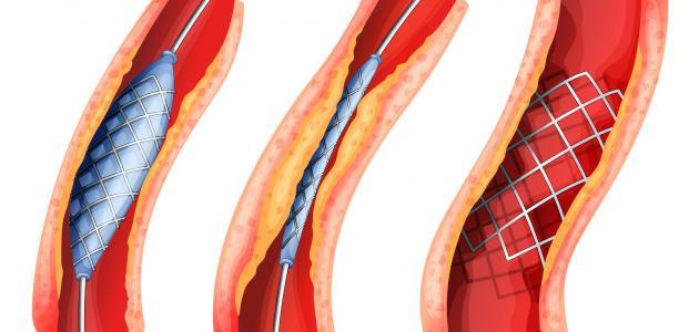 أسباب تصلب الشرايين أسباب تصلب الشرايين
