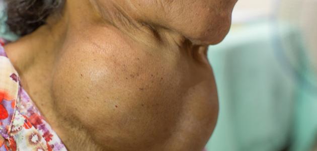 أسباب تضخم الغدة الدرقية