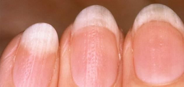 أسباب تغير لون الأظافر أسباب تغير لون الأظافر