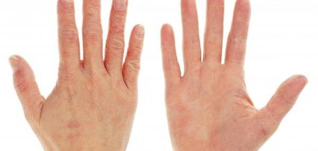 أسباب جفاف اليدين