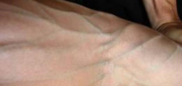 أسباب ظهور العروق الخضراء في اليدين