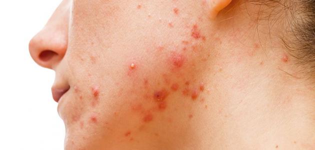 أسباب ظهور حب الشباب في الوجه أسباب ظهور حب الشباب في الوجه